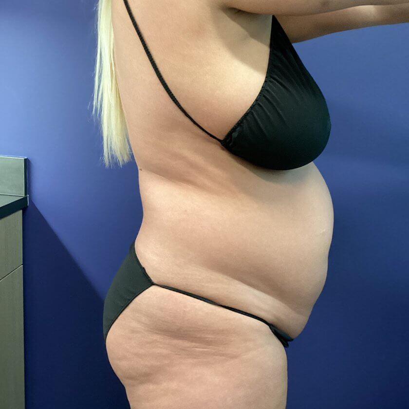 Liposuction before and after - before