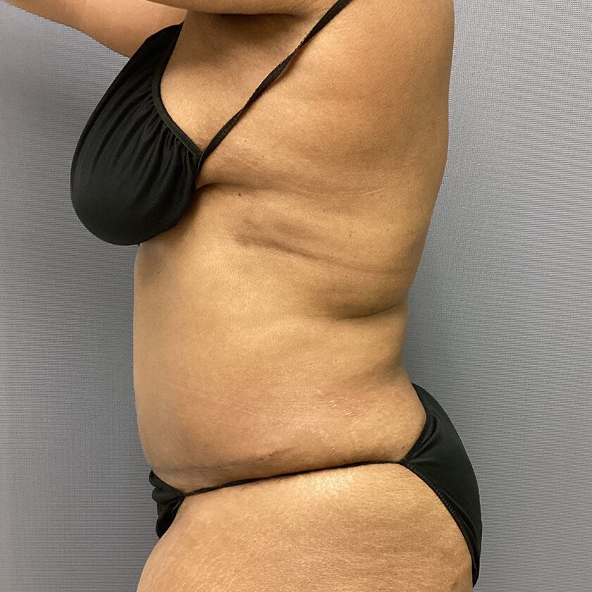 Tummy Tuck before and after - after