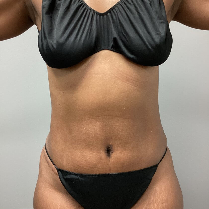 Mommy Makeover before and after - after