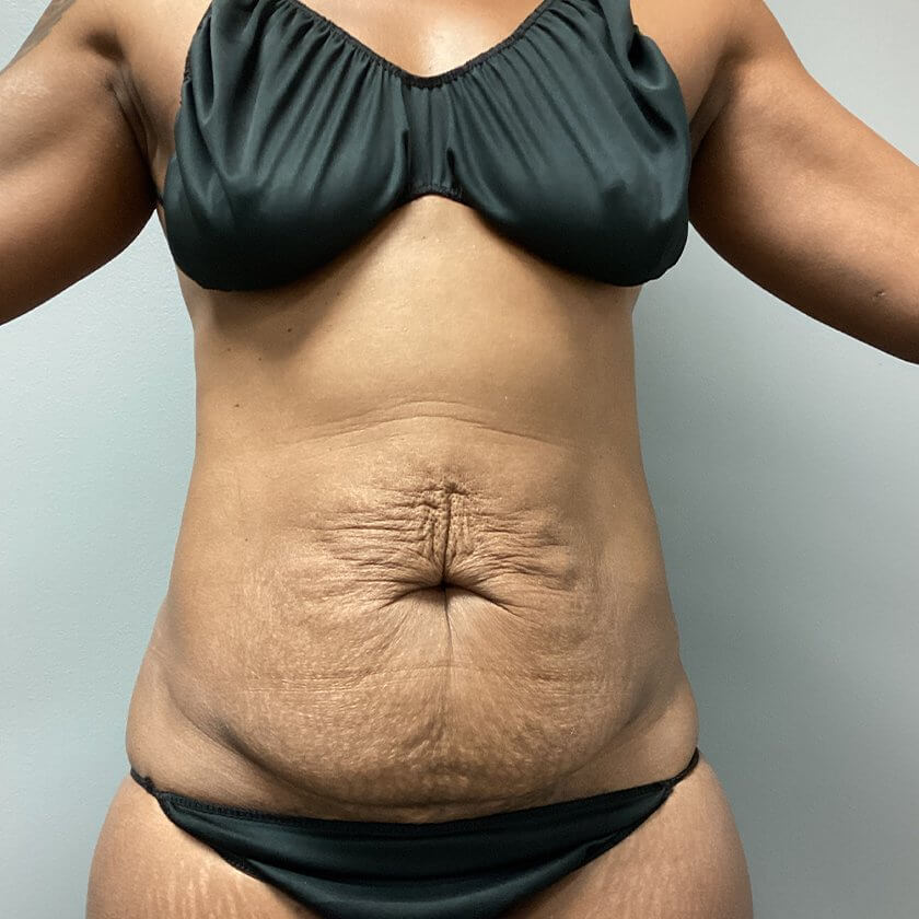Mommy Makeover before and after - before