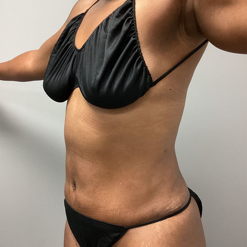 Liposuction before and after - after