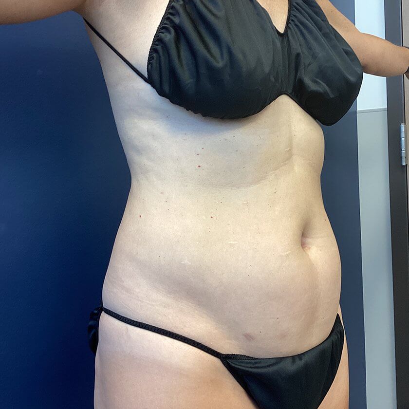 Liposuction before and after - before