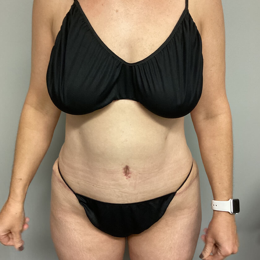 Tummy Tuck before and after - after