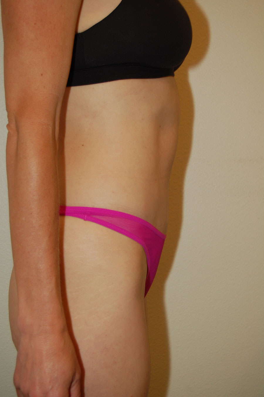 Procedure before and after - after