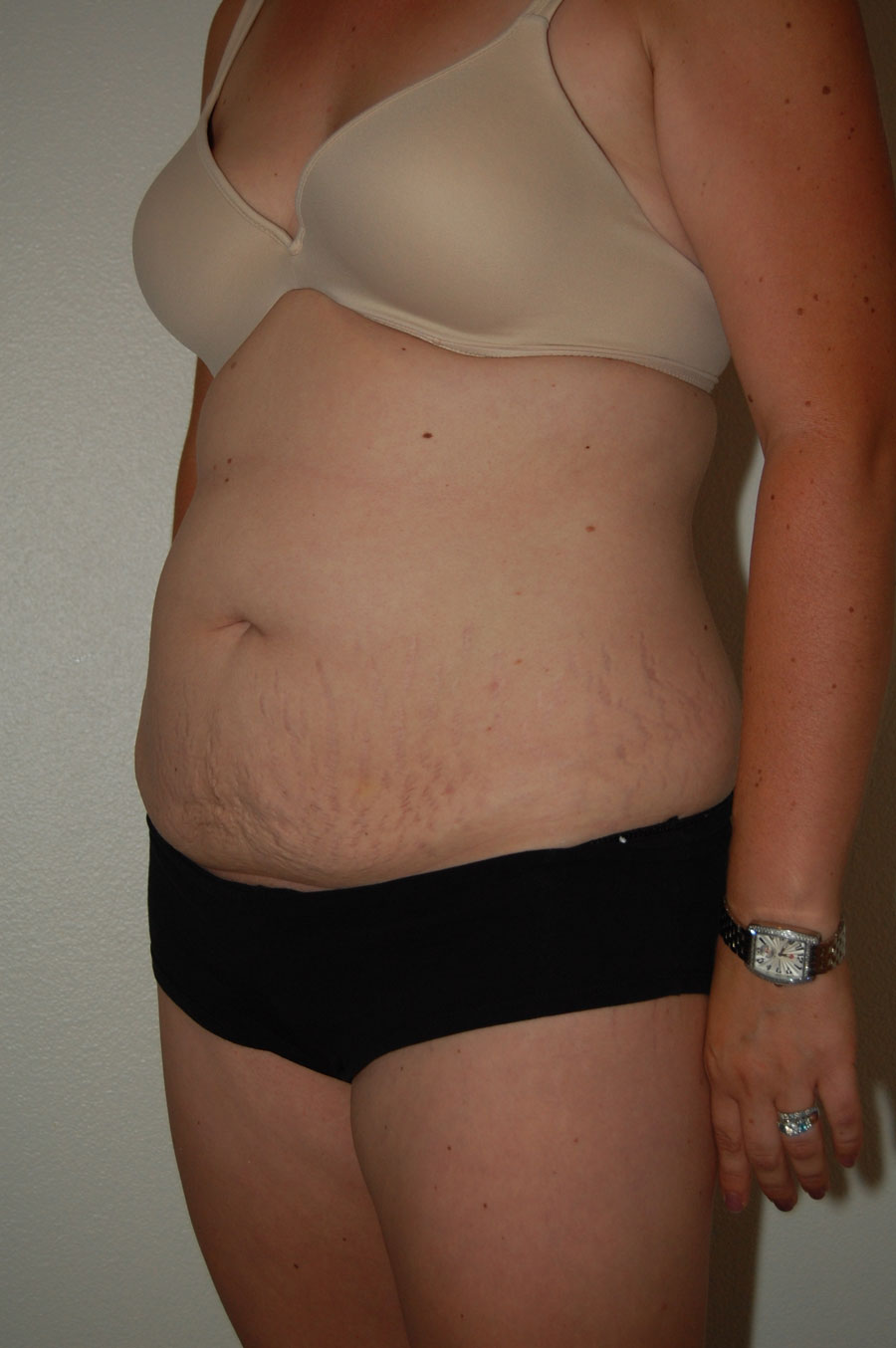 Procedure before and after - before