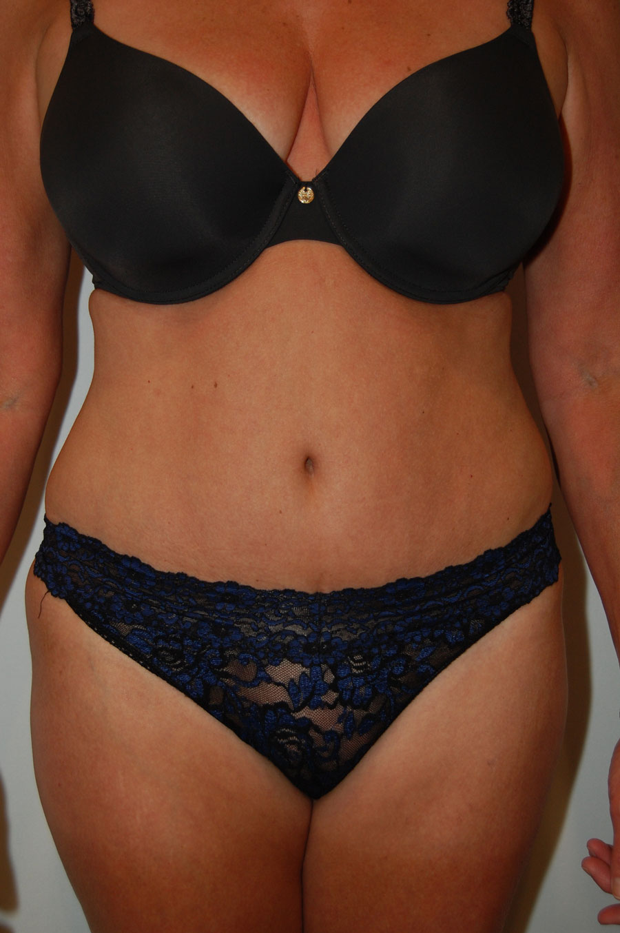 Procedure before and after - after