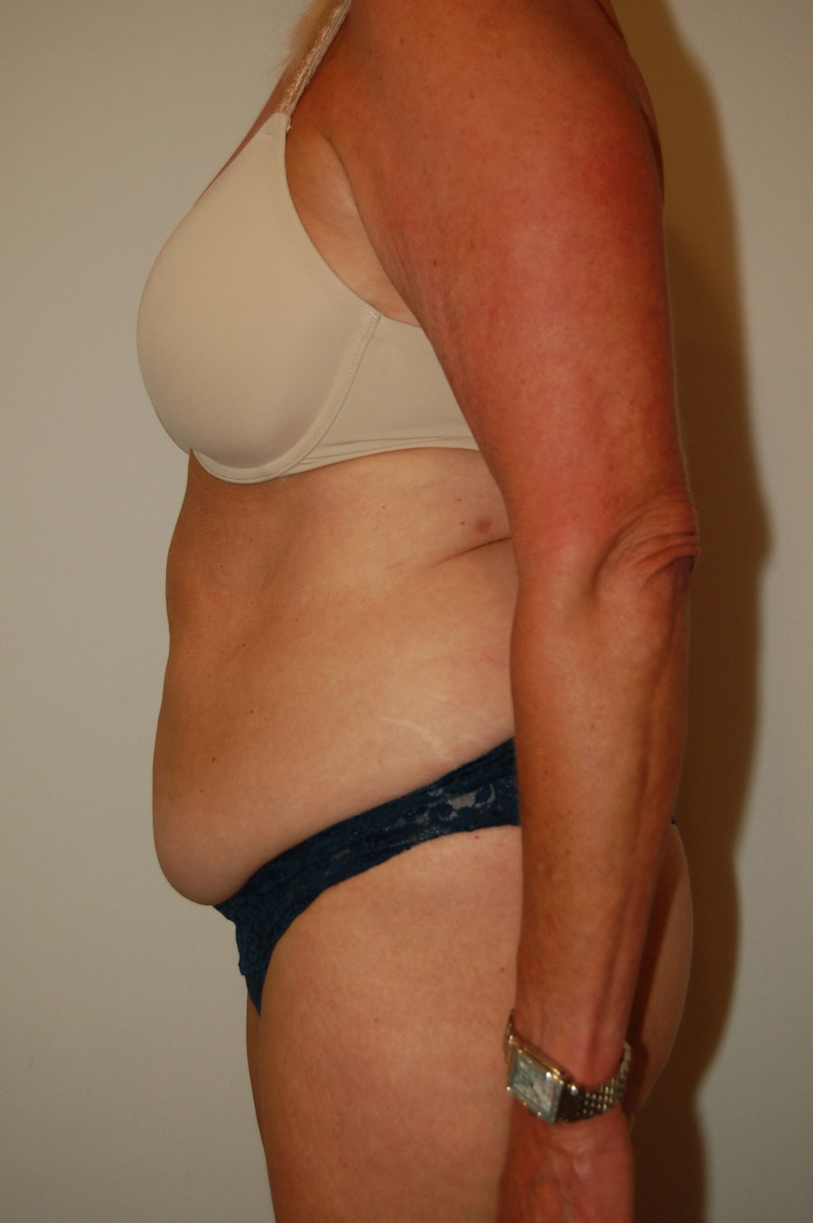 Procedure before and after - before