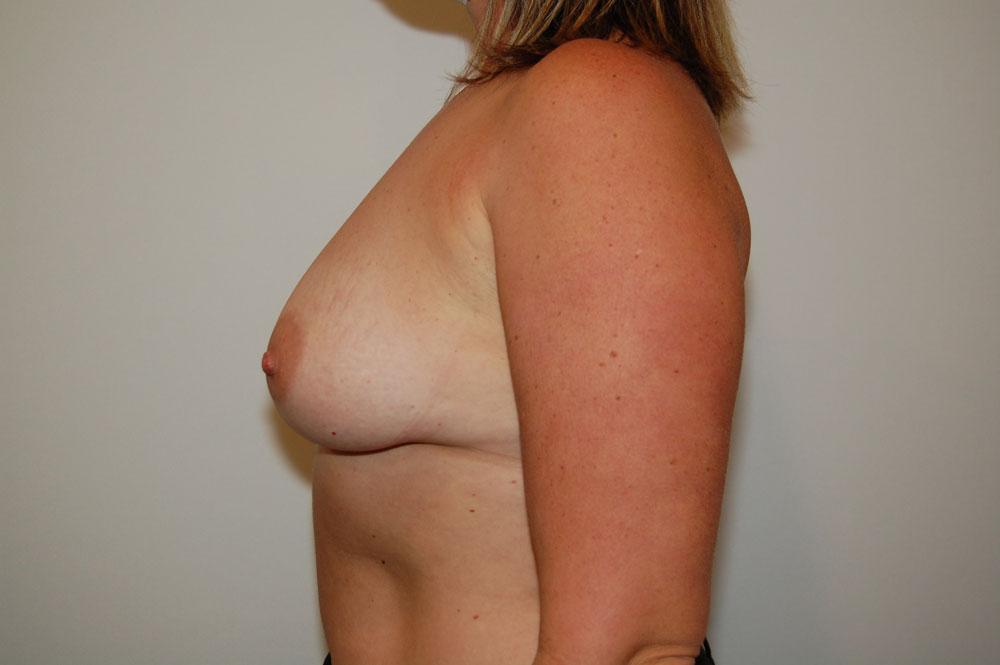 Procedure before and after - before