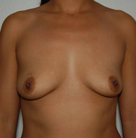 Breast Augmentation before and after - before