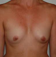 Breast Augmentation before and after - before