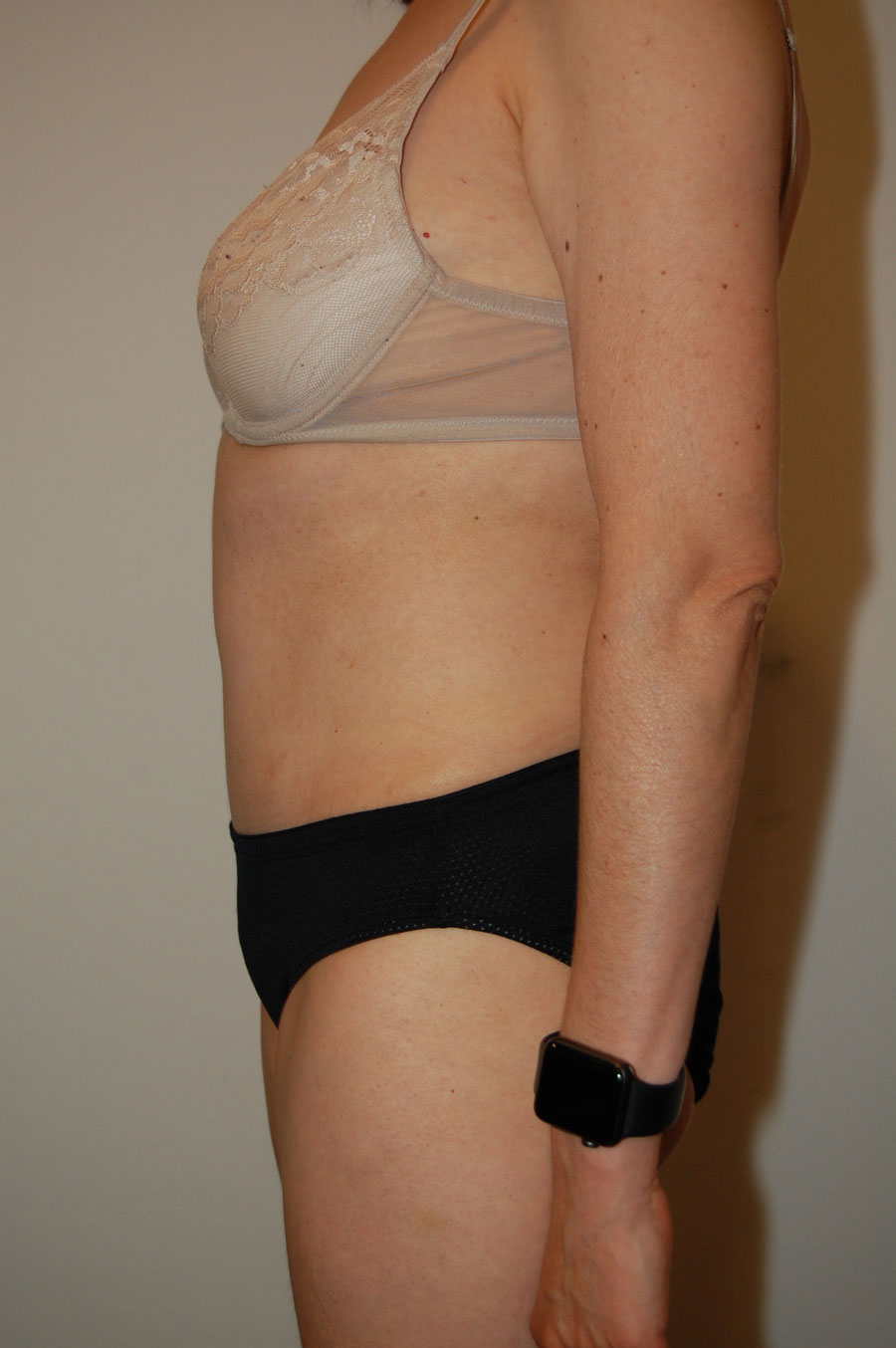 Procedure before and after - after