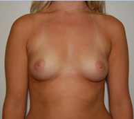 Breast Augmentation before and after - before