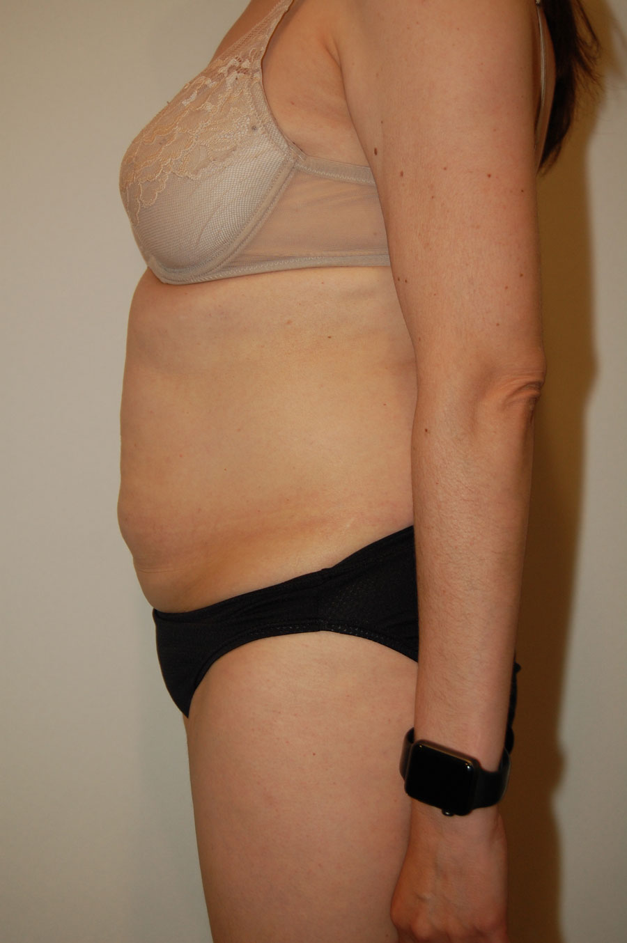 Procedure before and after - before