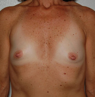 Breast Augmentation before and after - before