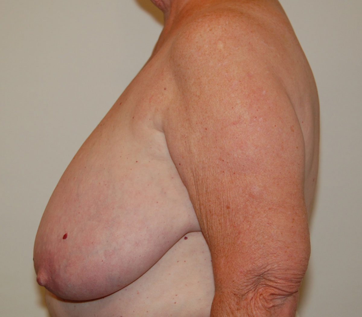Breast Reduction before — Dr. William Umansky