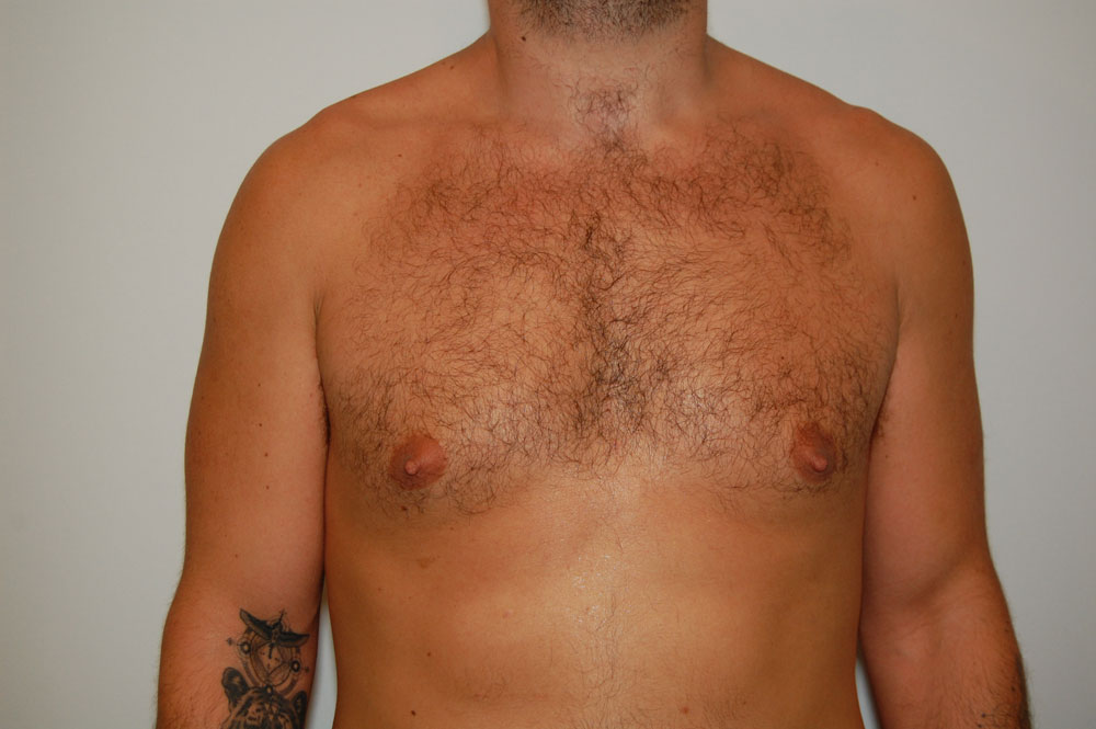 Procedure before and after - before