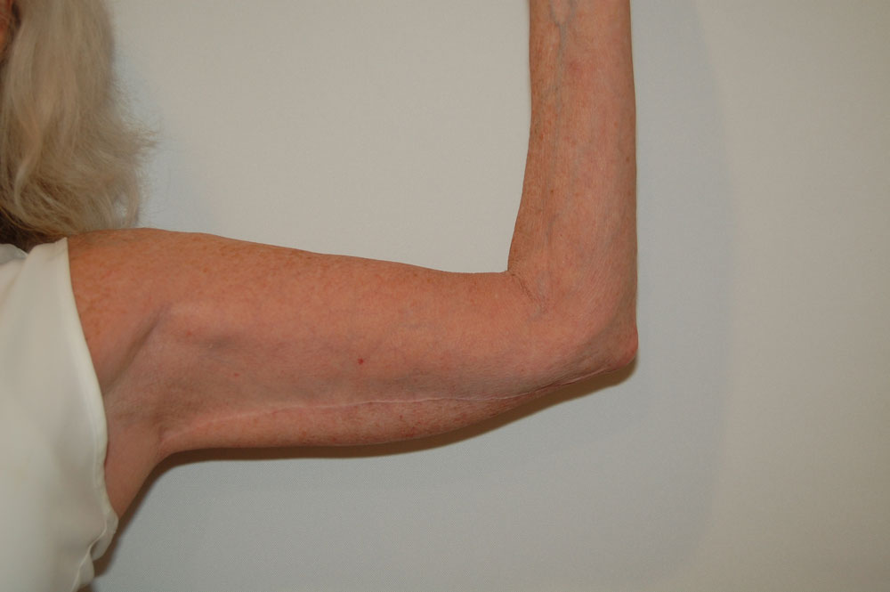 Arm Lift after — Dr. William Umansky