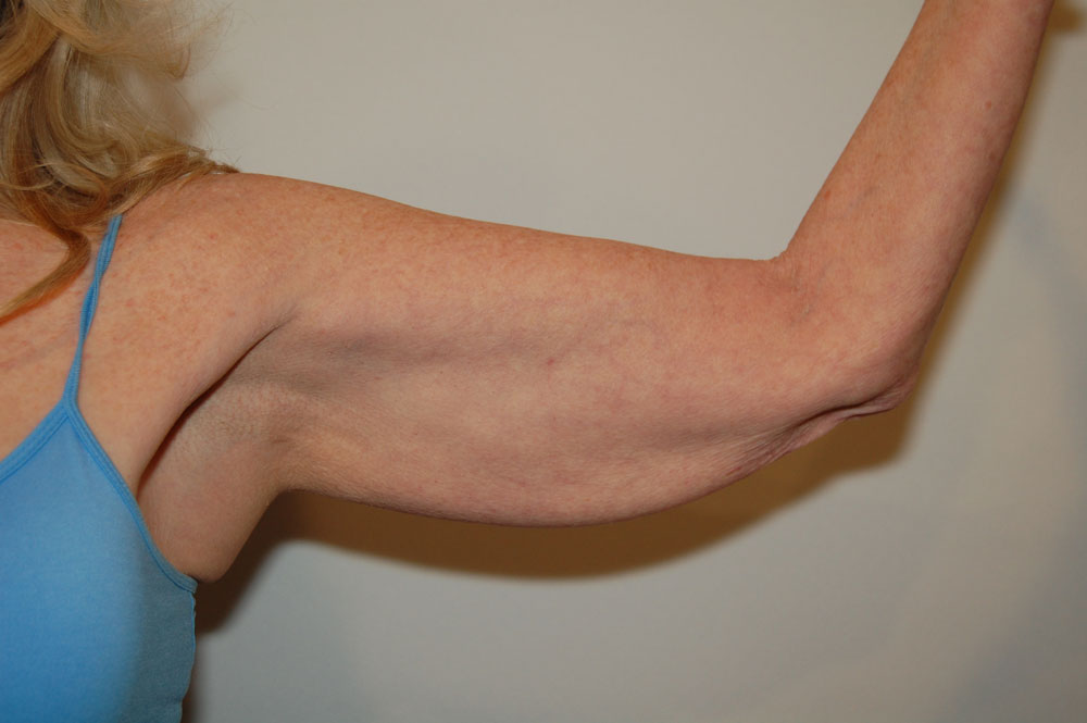 Arm Lift before — Dr. William Umansky