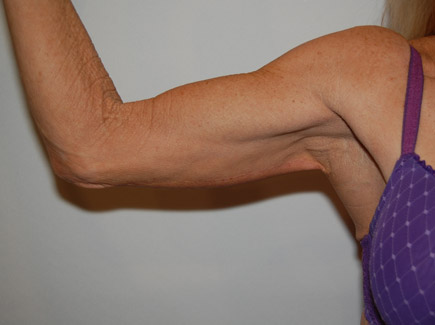 Arm Lift after — Dr. William Umansky