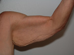 Arm Lift before — Dr. William Umansky