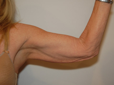 Arm Lift before — Dr. William Umansky