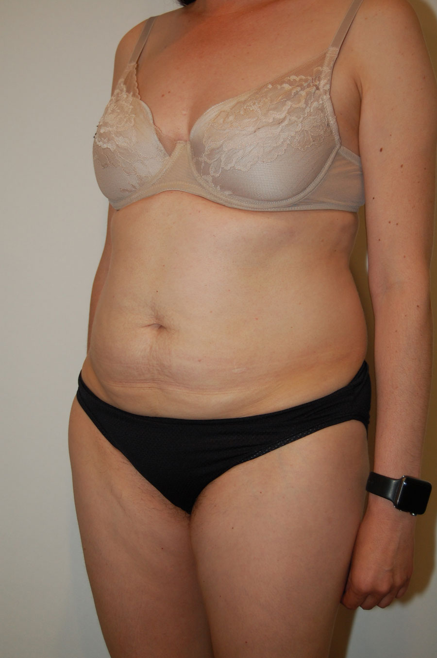 Procedure before and after - before