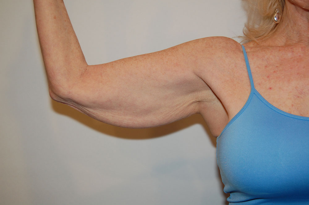 Arm Lift before — Dr. William Umansky