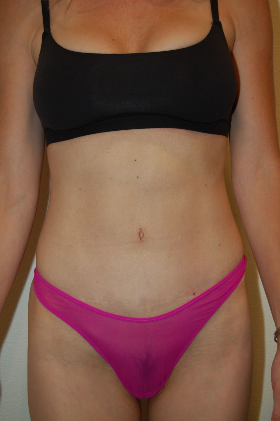 Procedure before and after - after