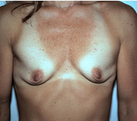Breast Augmentation before and after - before