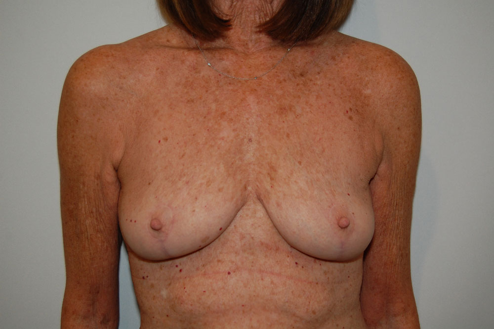Breast Augmentation before and after - after