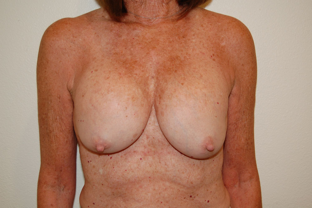 Breast Augmentation before and after - before