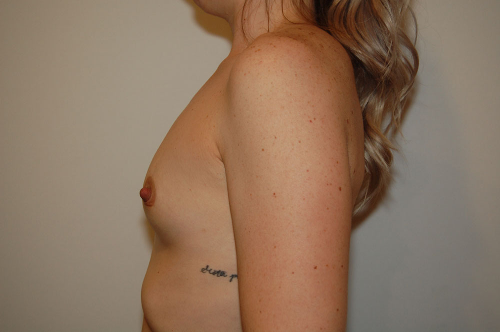 Breast Augmentation before and after - before