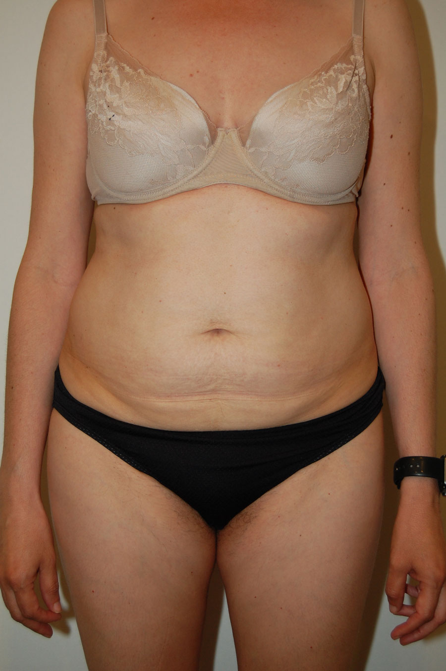 Procedure before and after - before