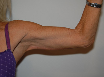 Arm Lift after — Dr. William Umansky