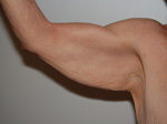 Arm Lift before — Dr. William Umansky