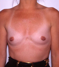 Breast Augmentation before and after - before