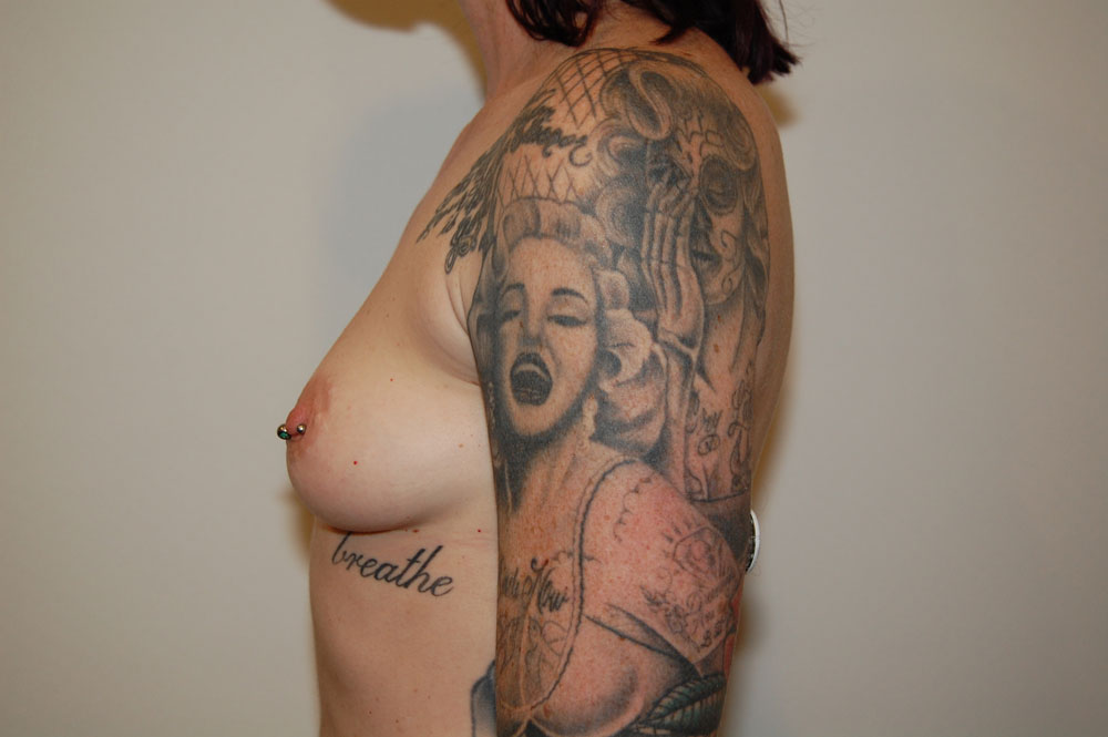Breast Augmentation before and after - before
