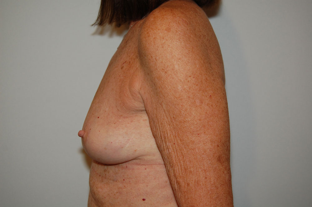 Breast Augmentation before and after - after