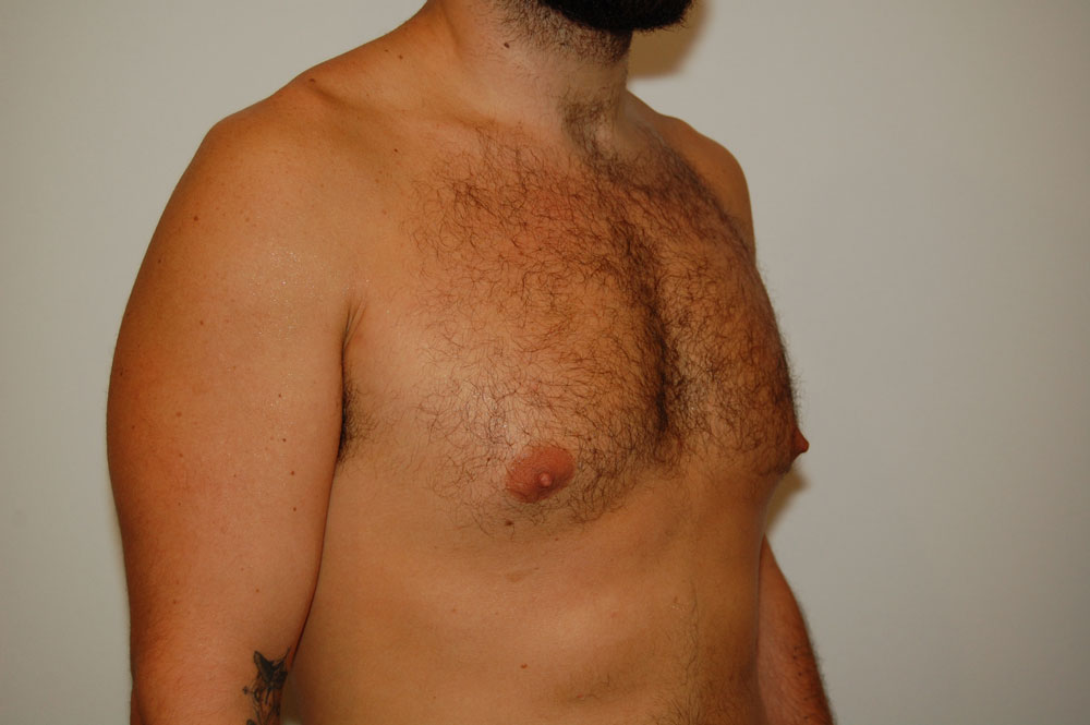 Procedure before and after - before