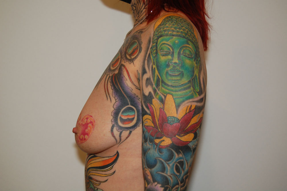 Breast Augmentation before and after - before