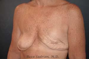 Breast Asymmetry Correction before and after - before