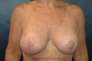 Breast Asymmetry Correction before and after - after