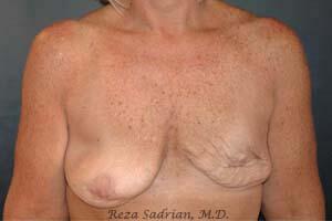 Breast Asymmetry Correction before and after - before