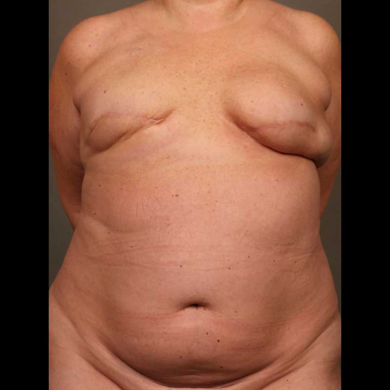 Breast Reconstruction Diep Flap before and after - before