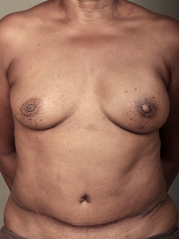 Breast Reconstruction Diep Flap: Nipple Sparing Mastectomy before and after - after