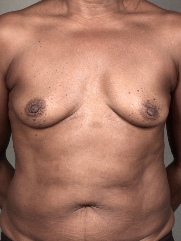 Breast Reconstruction Diep Flap: Nipple Sparing Mastectomy before and after - before