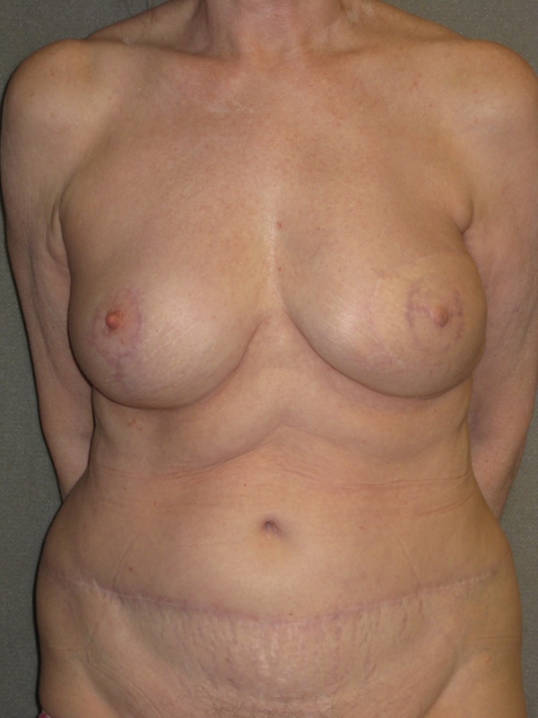 Breast Reconstruction Diep Flap before and after - after