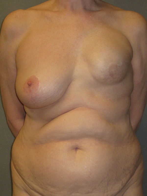 Breast Reconstruction Diep Flap before and after - before