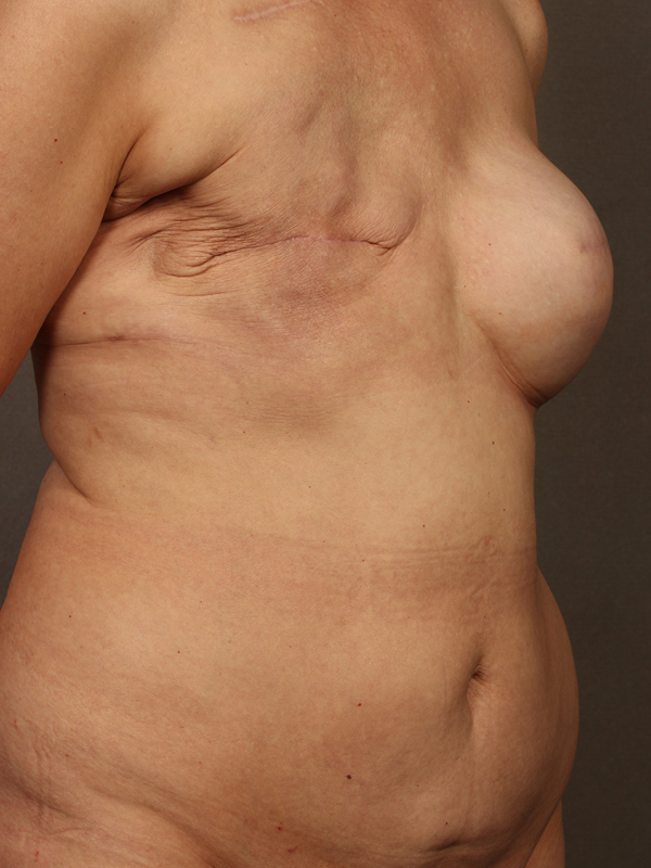 Breast Reconstruction Diep Flap before and after - before