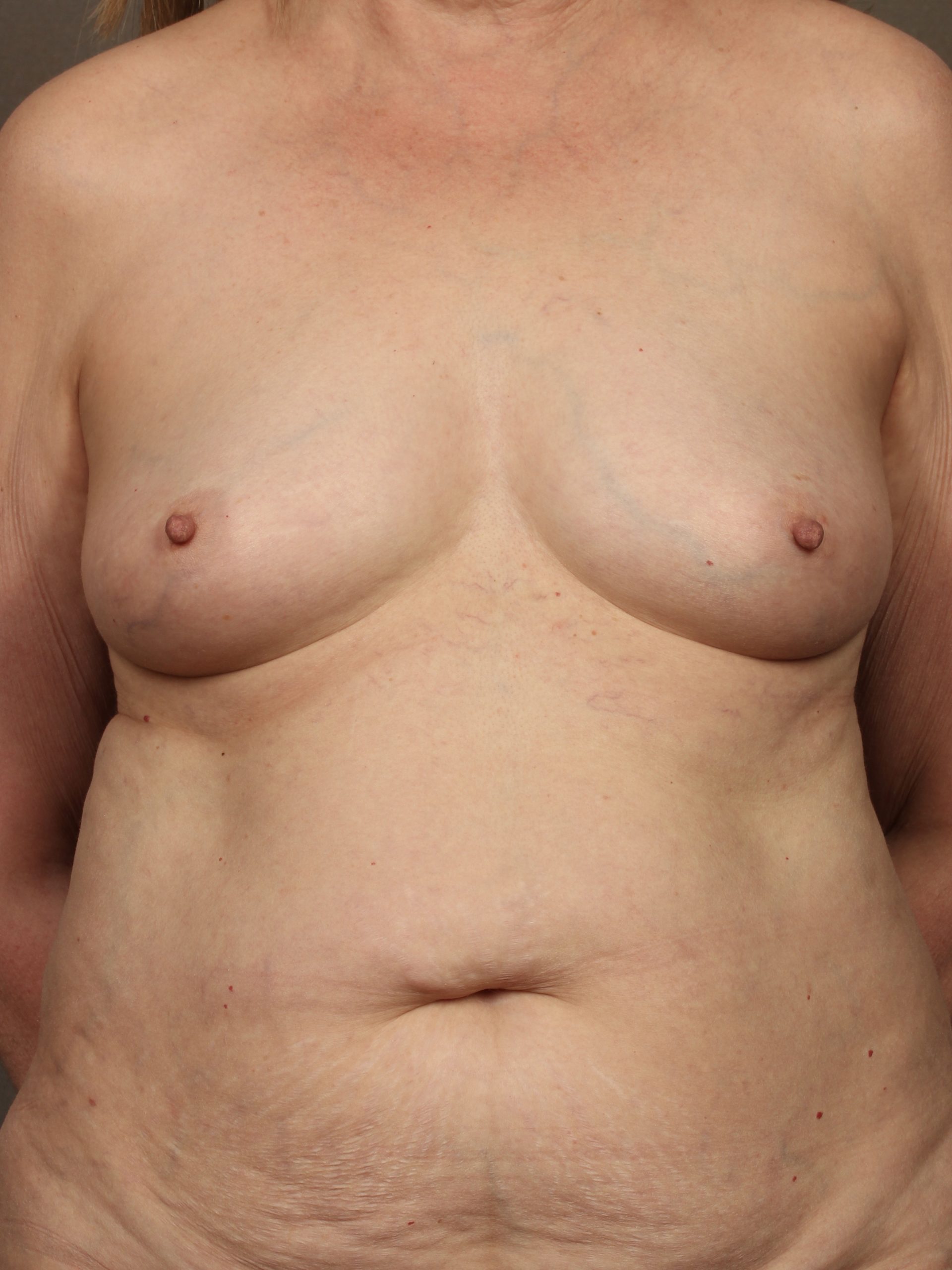 Breast Reconstruction Diep Flap: Nipple Sparing Mastectomy before and after - before
